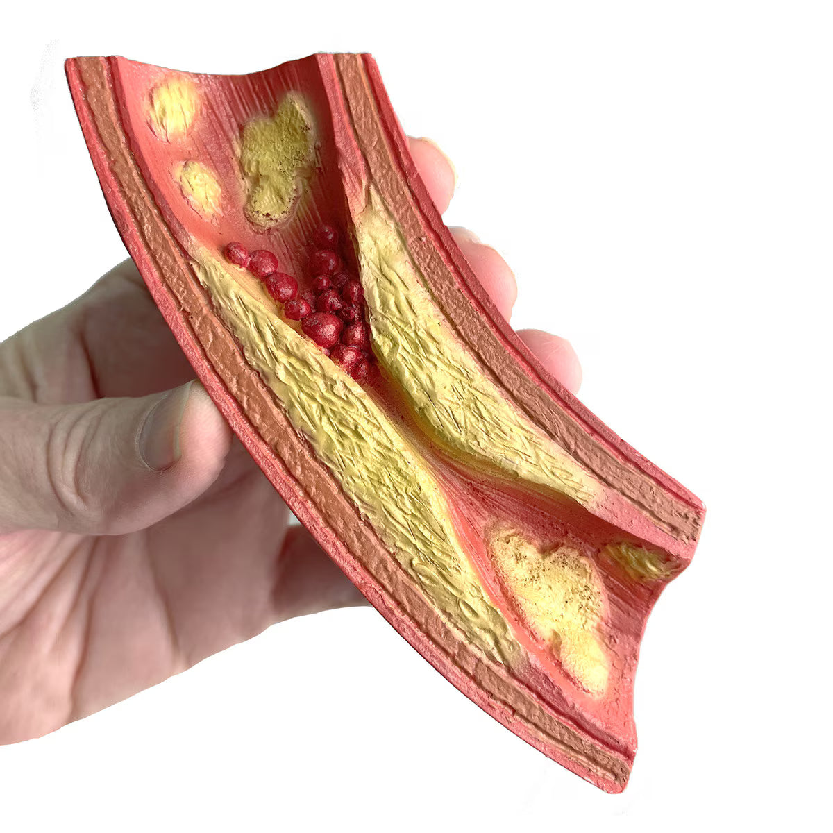 Deadly Obstruction Artery Model – Heart Health Display