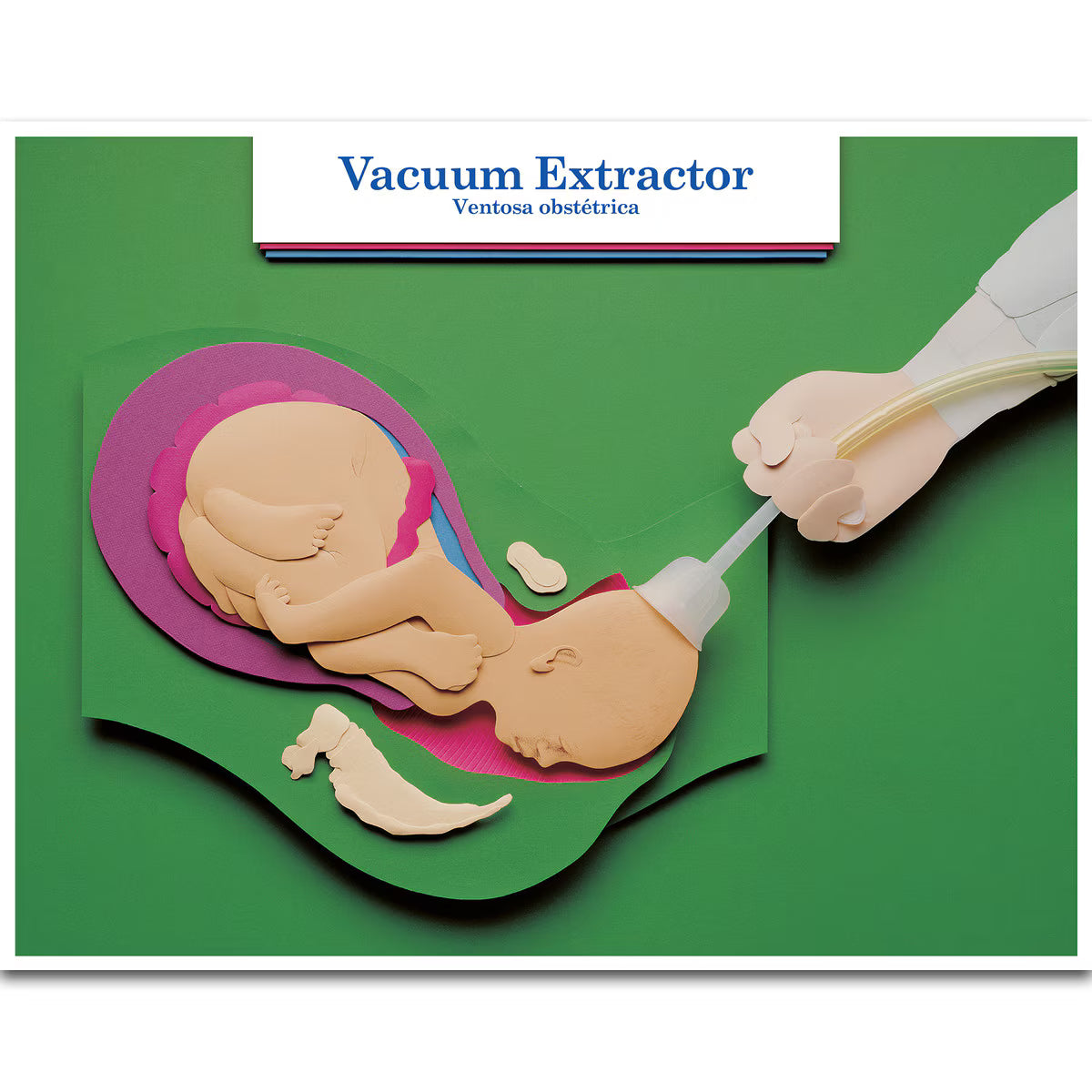 Labour & Birth Intervention Chart Set – Bilingual English/Spanish