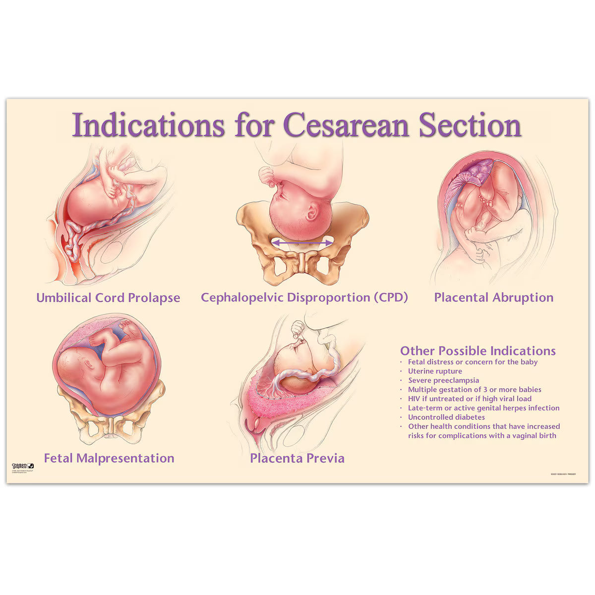 Indications for Cesarean Section Chart-Teaching Aids-Birth Supplies Canada