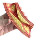Deadly Obstruction Artery Model – Heart Health Display