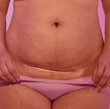 C-Section Silicone Scar Patches | FridaMom-C-Section Supplies-Birth Supplies Canada
