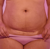 C-Section Silicone Scar Patches | FridaMom-Medical Supplies-Birth Supplies Canada