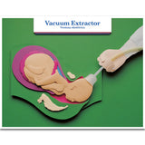 Labour & Birth Intervention Chart Set – Bilingual English/Spanish-Teaching Aids-Birth Supplies Canada