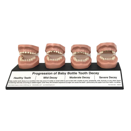 Progression Of Baby Bottle Tooth Decay Display-Teaching Aids-Birth Supplies Canada